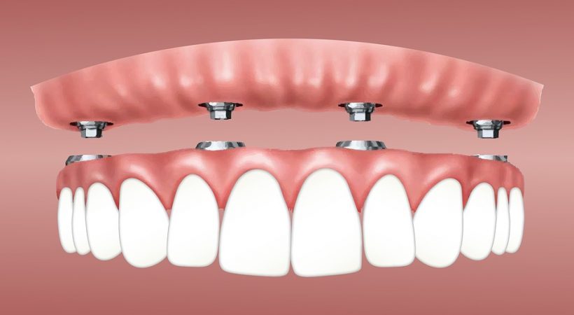 Dental Implant Procedure in London